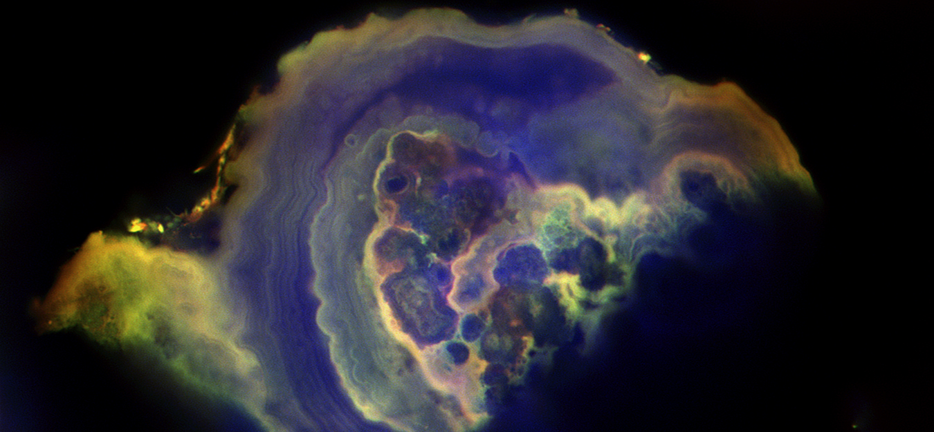 With the first detailed look inside breast tissue calcifications, Illinois researchers documented distinct differences between benign and cancerous deposits. In this sample of ductal carcinoma in situ, a precursor to invasive breast cancer, calcium phosphate nodules clumped together and were encrusted by thick layers of more calcium phosphate. Image by Mayandi Sivaguru
