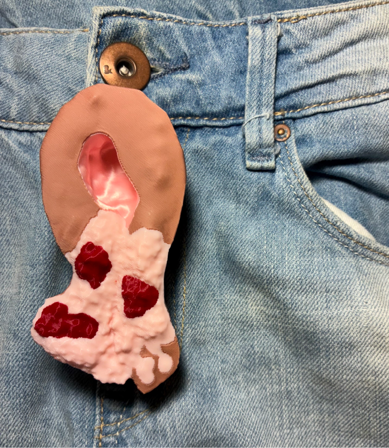 3D-Printed Model of Cervical Cancer.